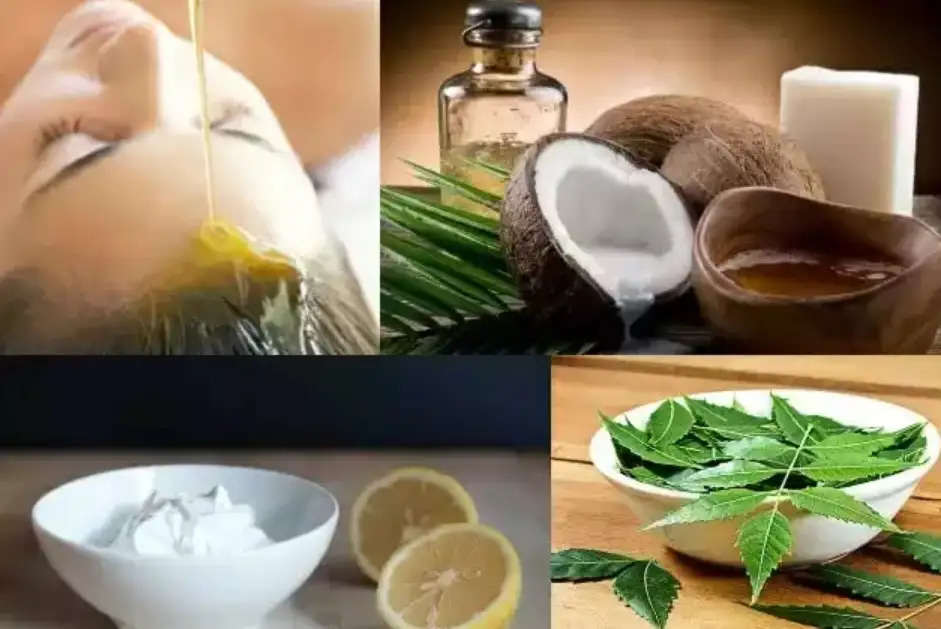 Dandruff Remedies : नारियल तेल में इन चीजों को मिलाकर करें सिर की मालिश, रूसी हो जाएगी कोसो दूर